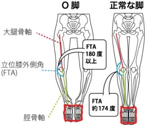 0脚と正常な足