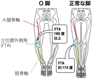 0脚の足と正常な足の状態